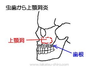 虫歯と上顎洞炎（副鼻腔炎）の関係