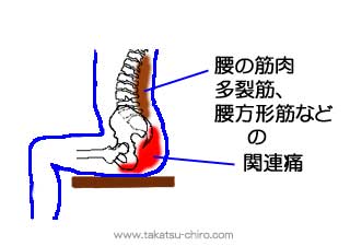 腰方形筋、多裂筋など腰の筋肉のトリガーポイント関連痛