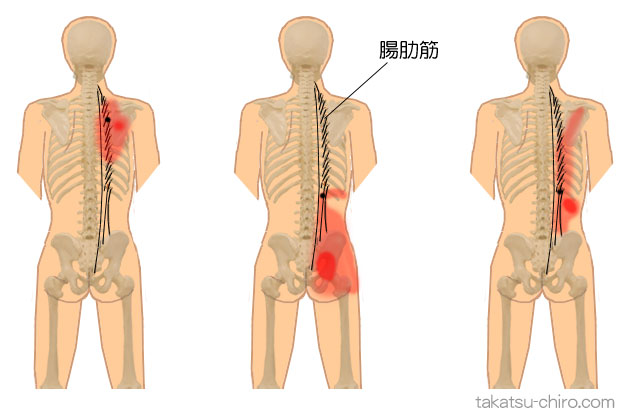 腸肋筋トリガーポイントの臀部痛の領域