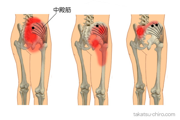中殿筋トリガーポイントの臀部痛の領域