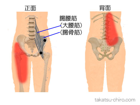 腸腰筋トリガーポイントの臀部痛の領域