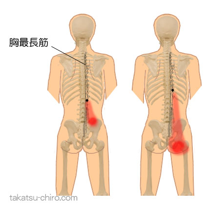胸最長筋トリガーポイントの臀部痛の領域