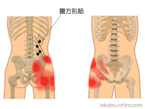 腰方形筋トリガーポイントの臀部痛の領域
