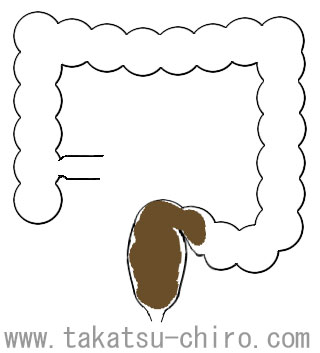 習慣性(直腸性)便秘