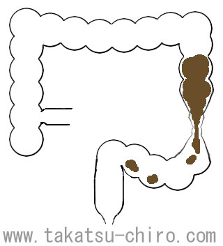 痙攣(けいれん)性便秘