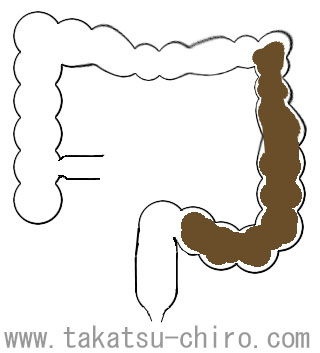 弛緩性(結腸性)便秘