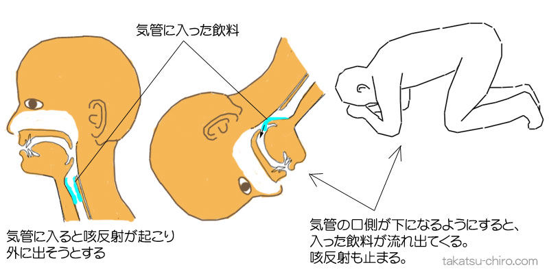 気管に水など飲料や唾が入ってむせるときの咳の止め方