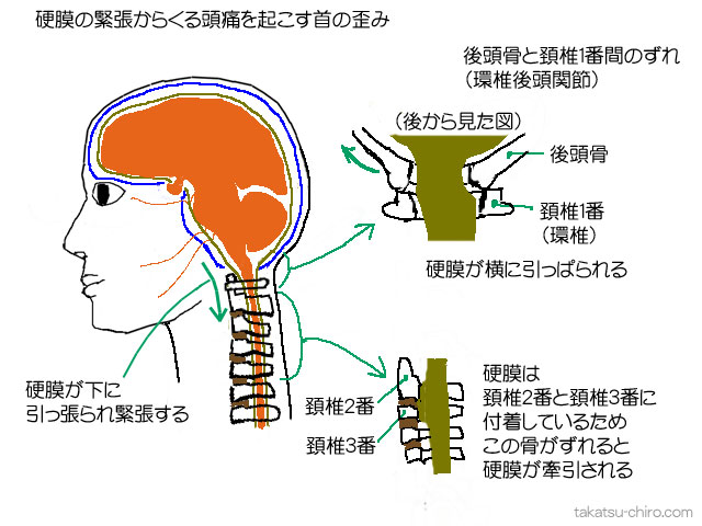 硬膜の緊張からくる頭痛を起こす首の歪み