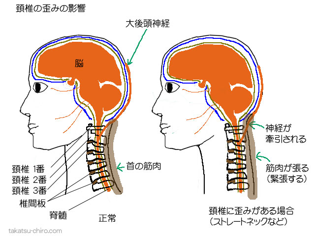 首の歪みからくる頭痛、大後頭神経の圧迫、首の筋肉の緊張